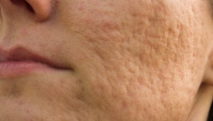 Sivilce izleri nasıl geçer? Yüzdeki sivilce lekeleri ve izleri için evde doğal tariflerle kesin çözüm